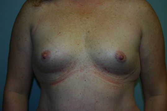Breast Augmentation Before & After