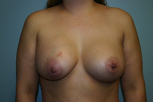 Breast Augmentation Before & After