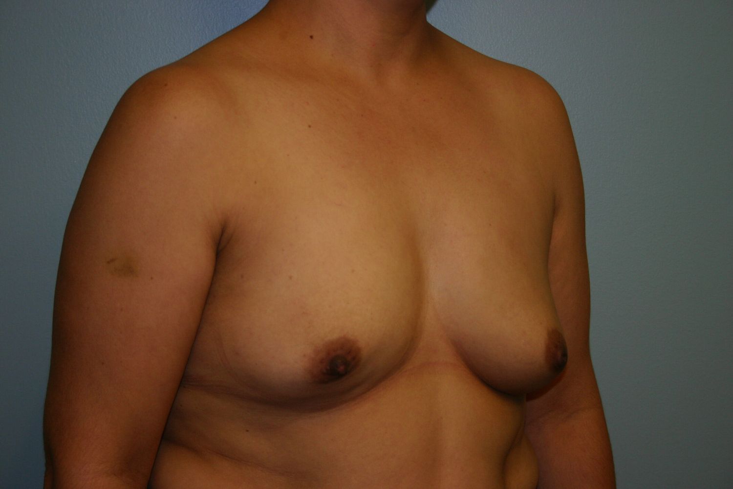 Breast Augmentation Before & After