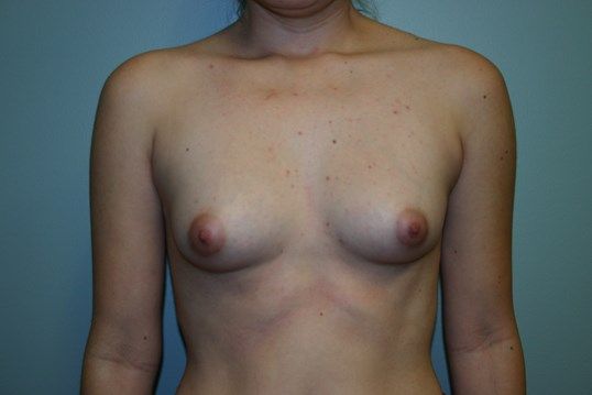 Breast Augmentation Before & After