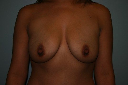 Breast Augmentation Before & After