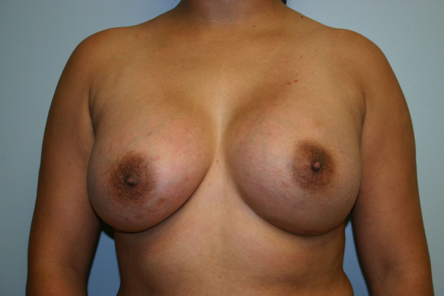 Breast Augmentation Before & After