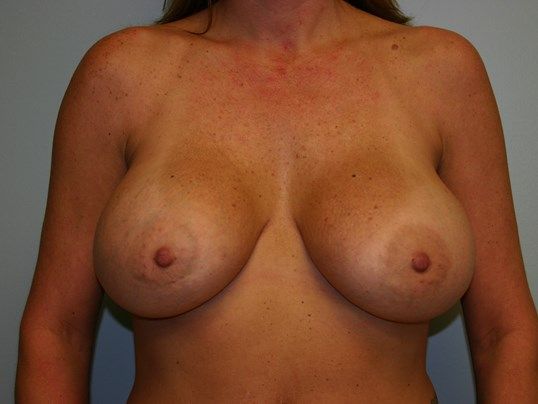 Breast Augmentation Before & After