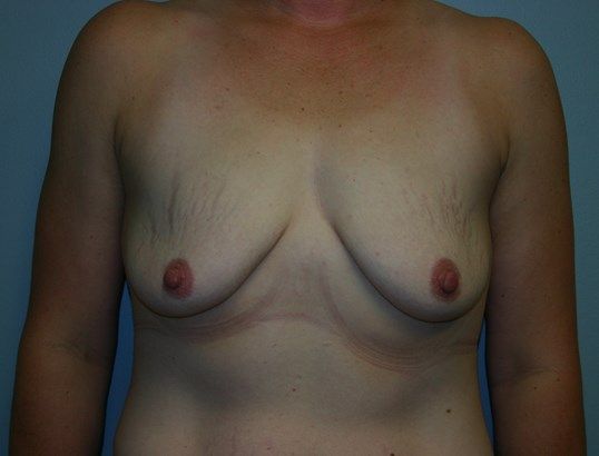 Breast Augmentation Before & After