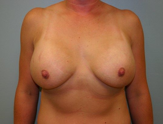 Breast Augmentation Before & After