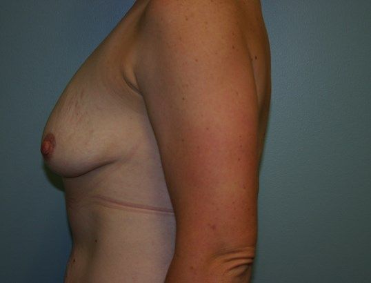 Breast Augmentation Before & After