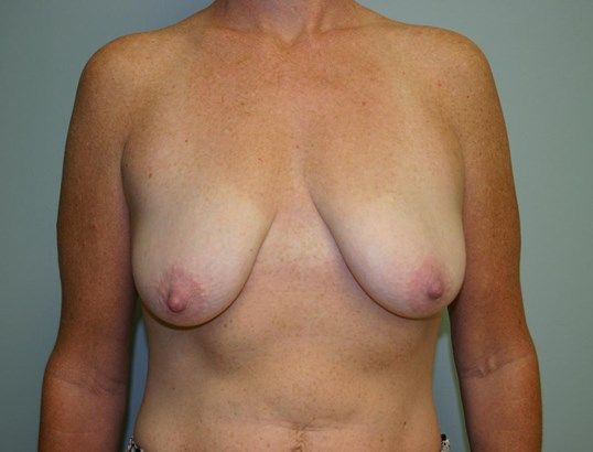 Breast Augmentation Before & After