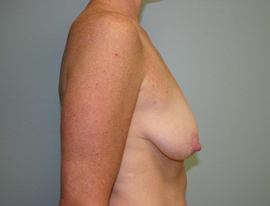 Breast Augmentation Before & After