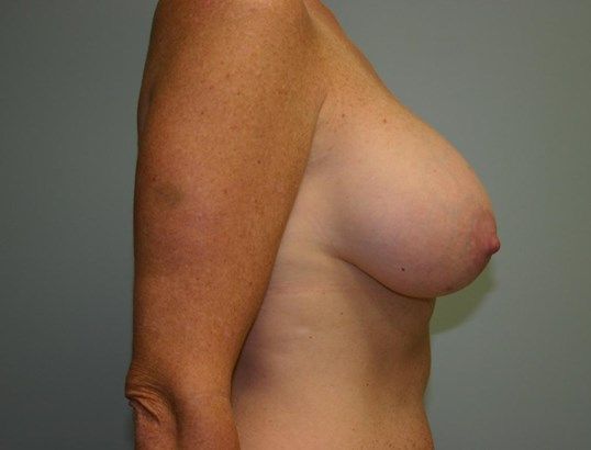 Breast Augmentation Before & After