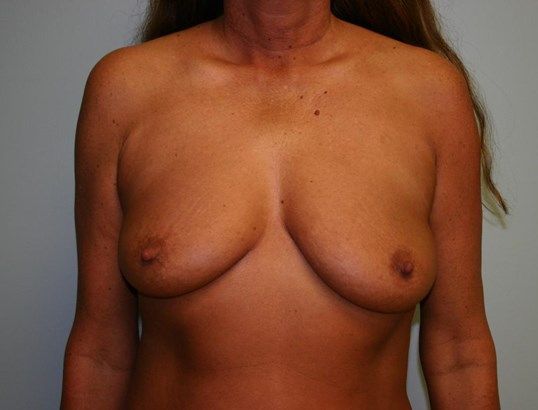 Breast Augmentation Before & After