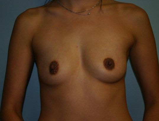 Breast Augmentation Before & After
