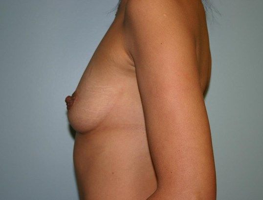 Breast Augmentation Before & After