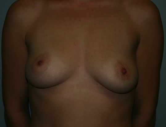 Breast Augmentation Before & After