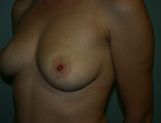 Breast Augmentation Before & After