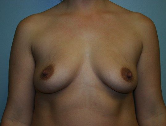 Breast Augmentation Before & After