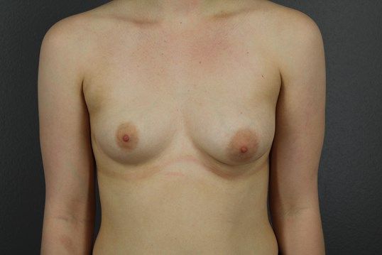 Breast Augmentation Before & After