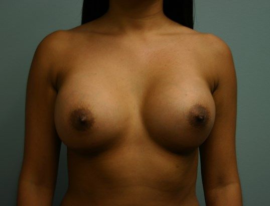 Breast Augmentation Before & After