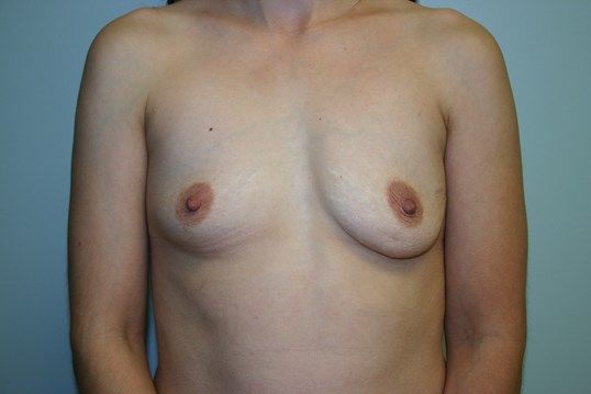 Breast Augmentation Before & After