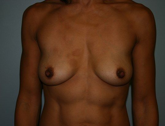 Breast Augmentation Before & After
