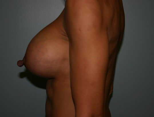 Breast Augmentation Before & After