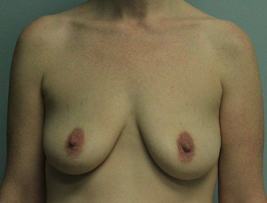 Breast Augmentation Before & After