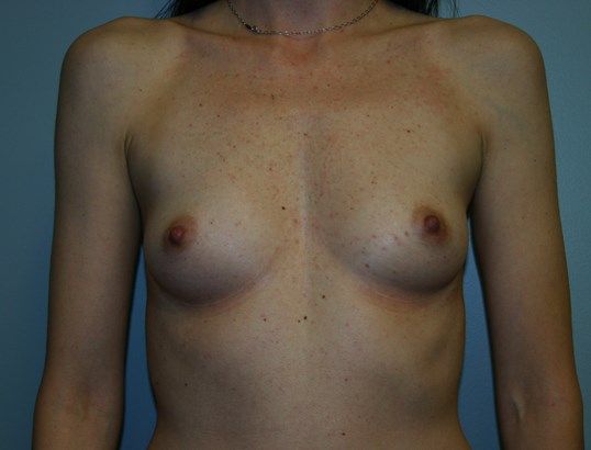 Breast Augmentation Before & After