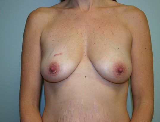Breast Augmentation Before & After