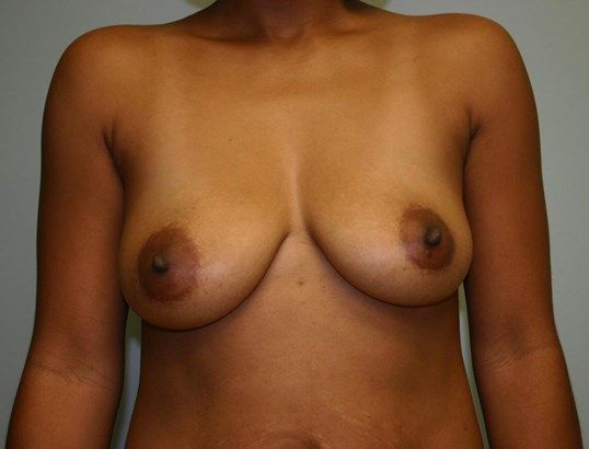 Breast Augmentation Before & After