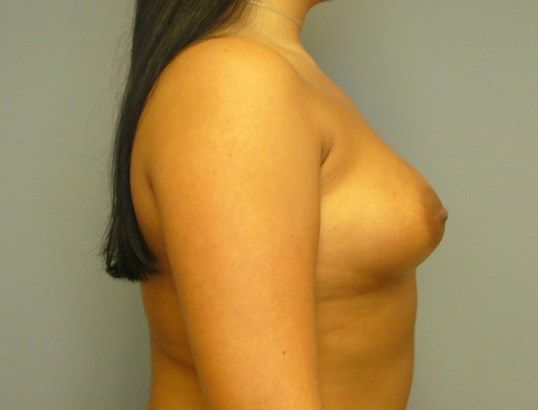 Breast Augmentation Before & After