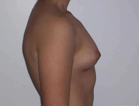 Breast Augmentation Before & After