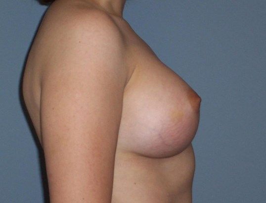 Breast Augmentation Before & After