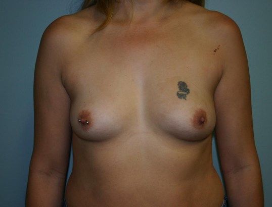 Breast Augmentation Before & After
