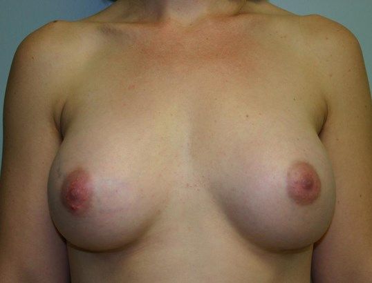 Breast Augmentation Before & After