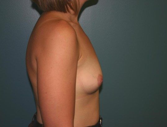 Breast Augmentation Before & After
