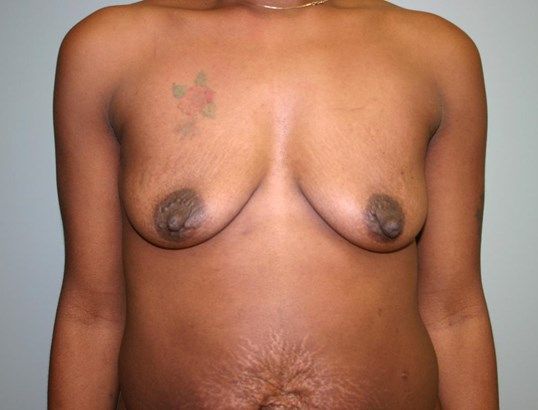 Breast Augmentation Before & After