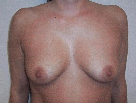 Breast Augmentation Before & After