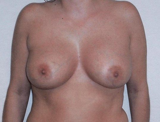 Breast Augmentation Before & After