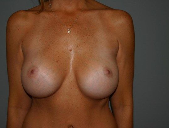 Breast Augmentation Before & After