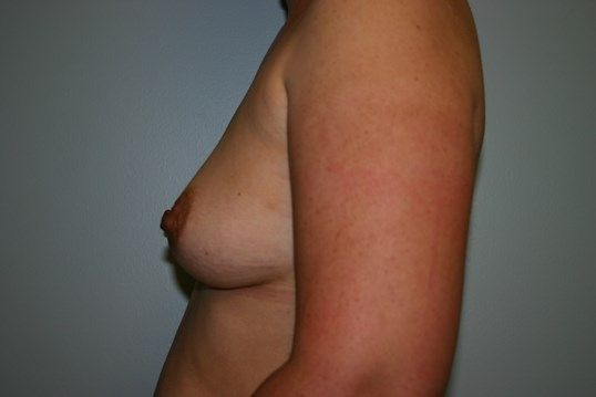 Breast Augmentation Before & After