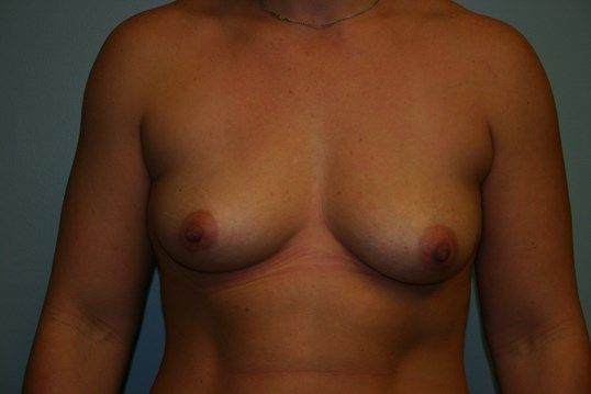 Breast Augmentation Before & After