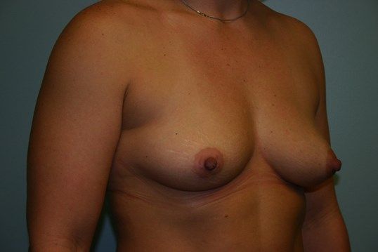Breast Augmentation Before & After