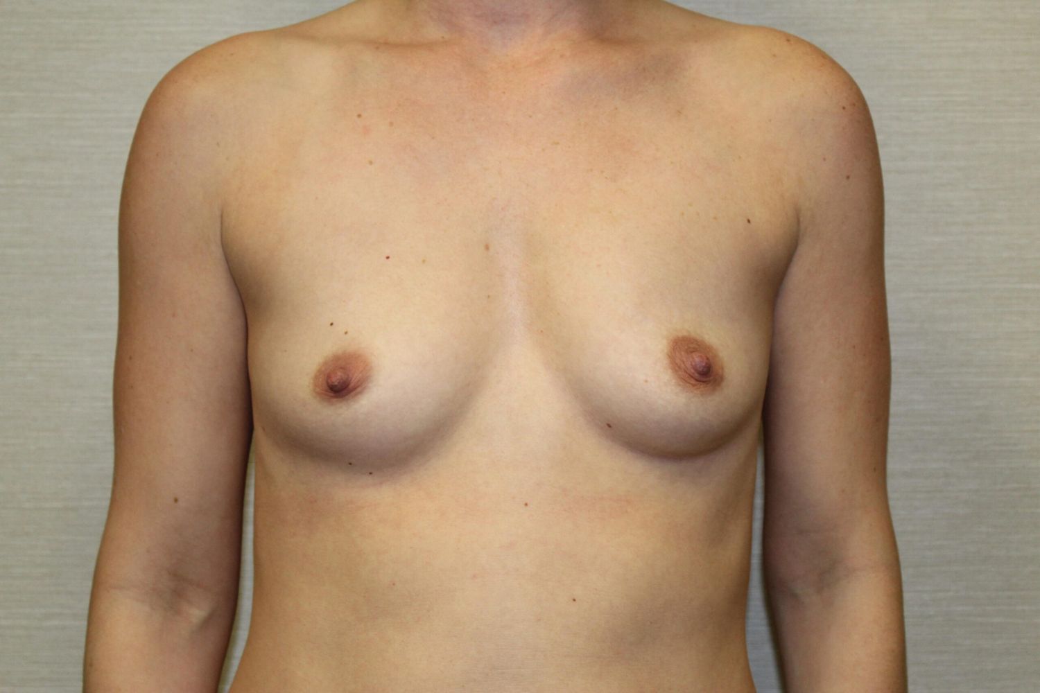Breast Augmentation Before & After