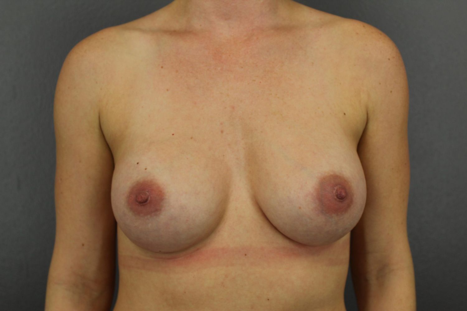 Breast Augmentation Before & After