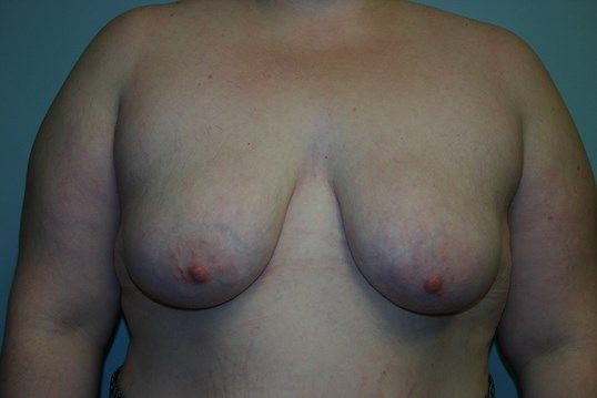 Breast Augmentation Before & After