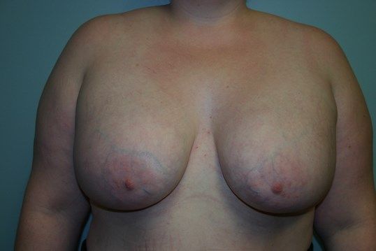 Breast Augmentation Before & After