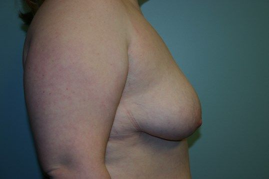 Breast Augmentation Before & After