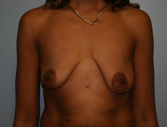 Breast Augmentation Before & After
