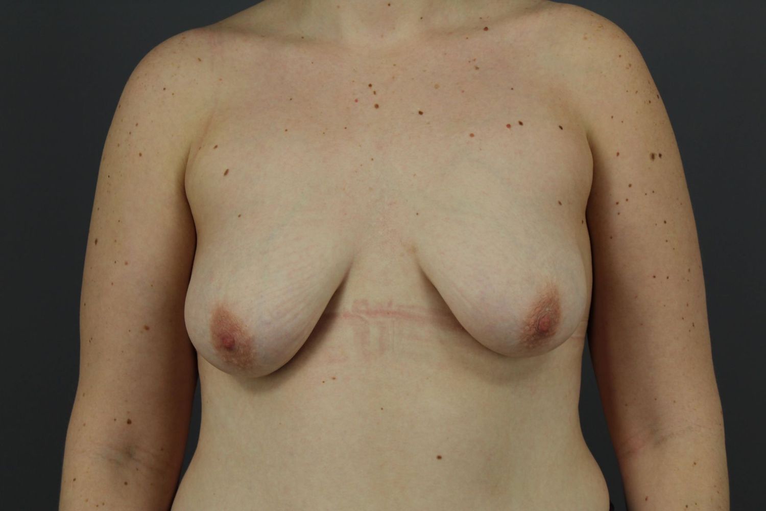 Breast Augmentation Before & After