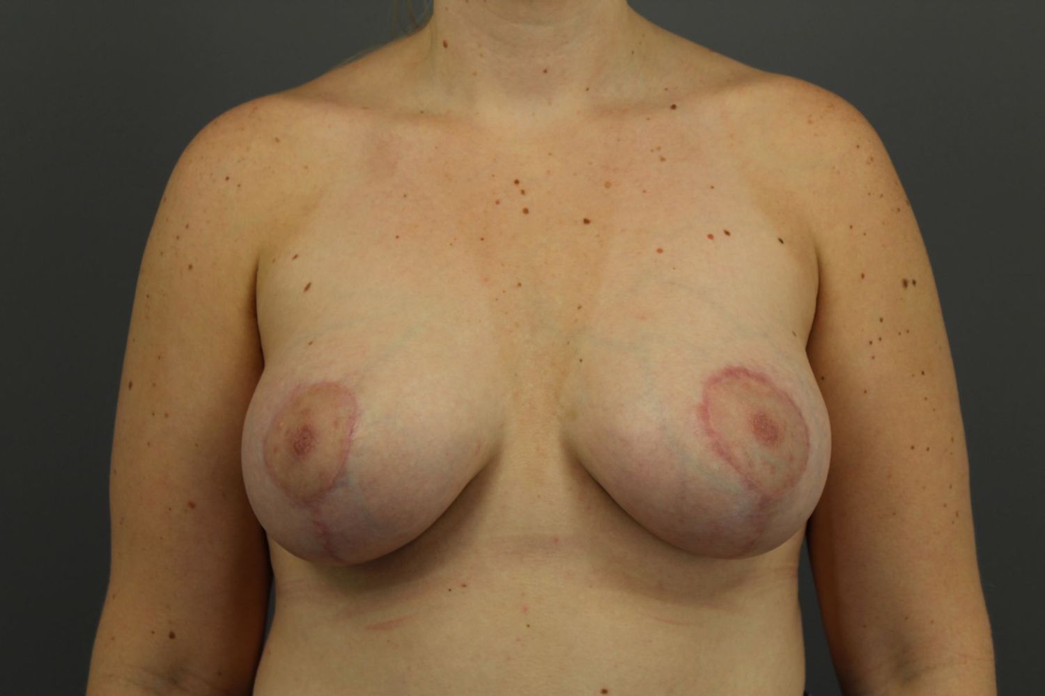 Breast Augmentation Before & After
