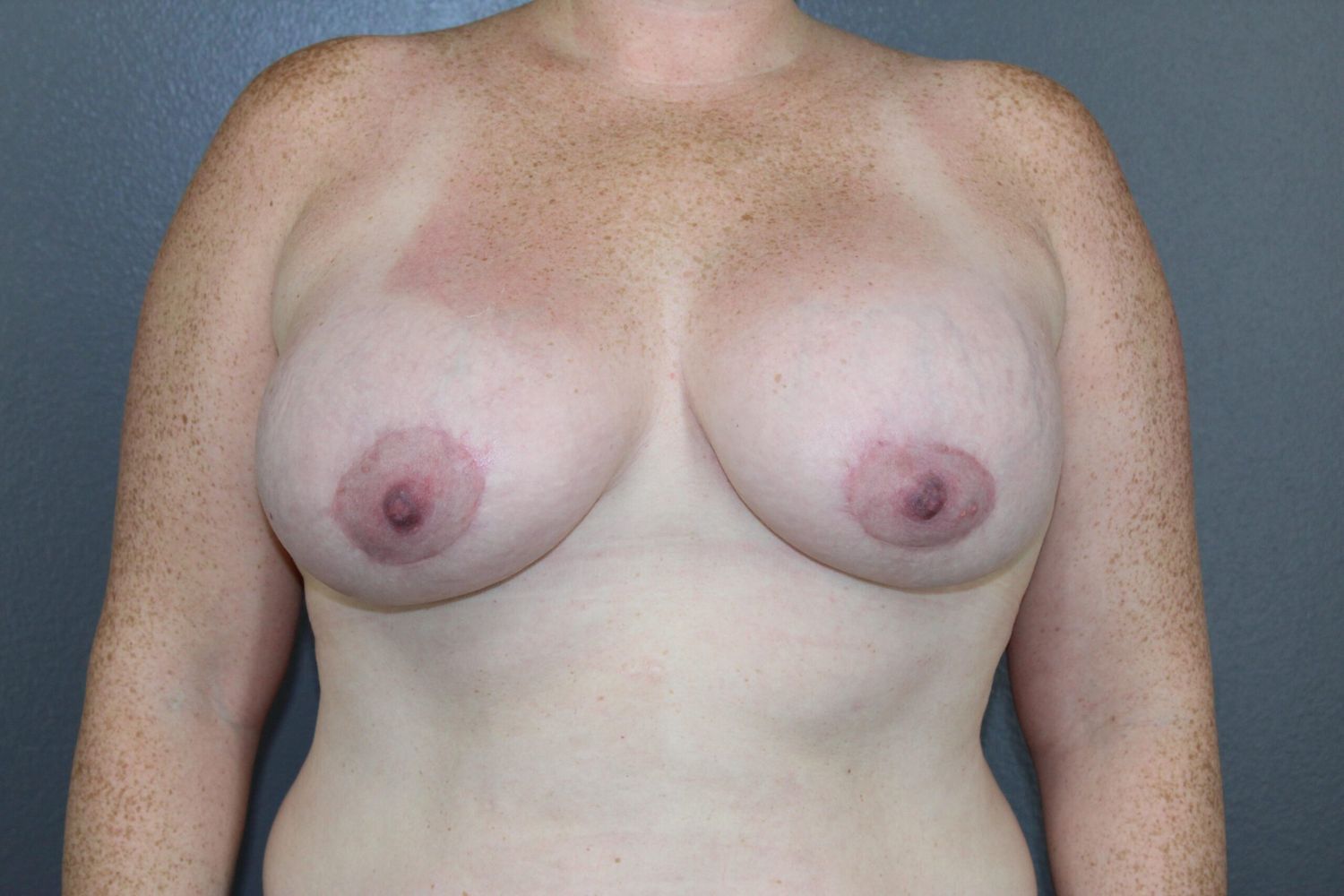 Breast Augmentation Before & After